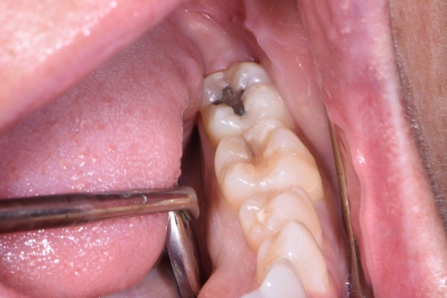 evaluating cracked teeth