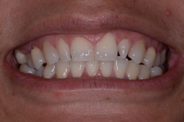 resizing orthodontic case