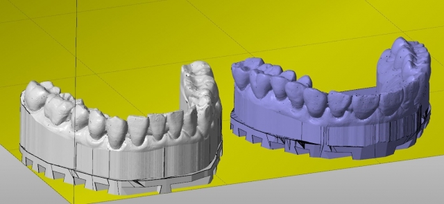 Working with CEREC Ortho's digital occlusion