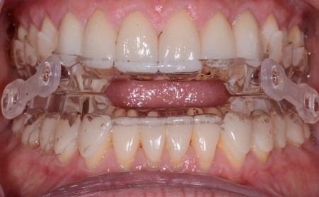 mandibular advancement device