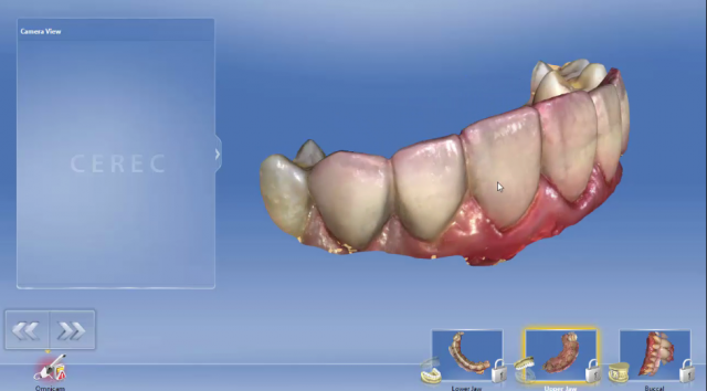 digital anterior bite plane figure 2