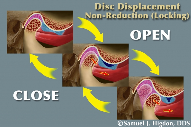 4 Steps to Simplifying TMD Diagnosis Spear Education