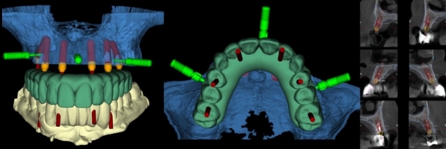 surgical dental guides