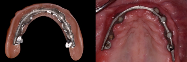 bar type overdenture prosthetic design