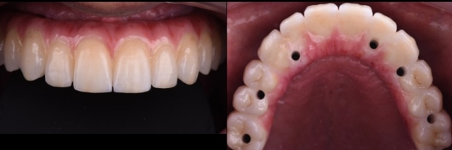 zirconia ceramics prosthesis