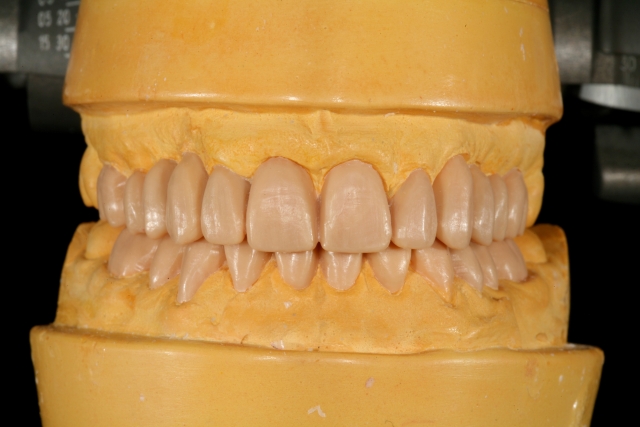 diagnostic wax-up figure 1