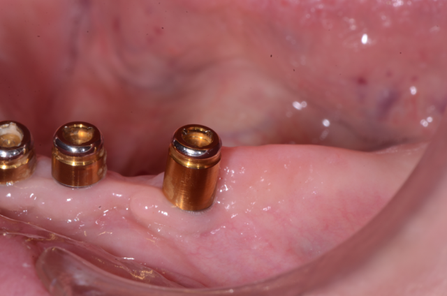 locator abutment figure 2