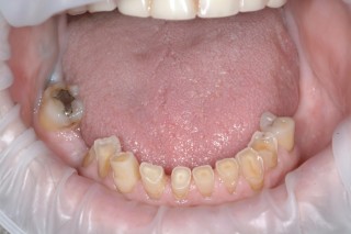 Patient's bottom row of teeth that are broken and worn flat on tops.