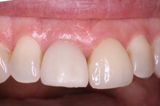 managing implant placement figure 3