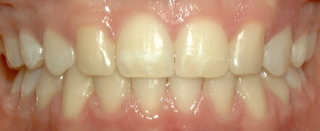 teeth after orthodontic treatment