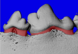 Gum Disease