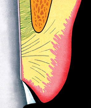 gingival margins
