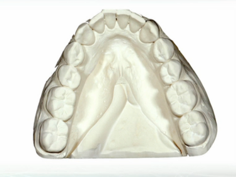 dental cast