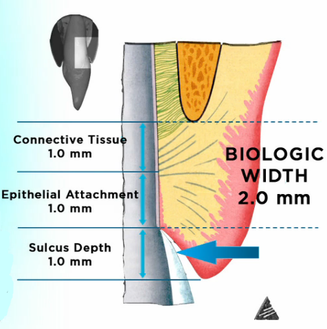 subgingival