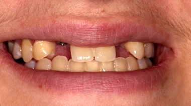 patient smile with congenitally missing maxillary lateral incisors