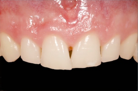 The Four Possible Causes for Lack of Tooth Display