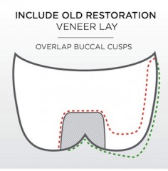 Include Old Restororation. Overlap buccal cusps.