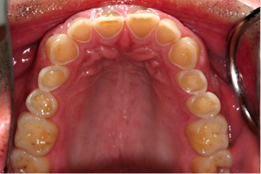 Patient's backside of teeth at age 36.