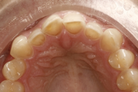 Simplify the Worn Dentition Diagnosis Process