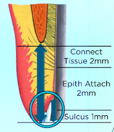 subgingival margin placement figure 1