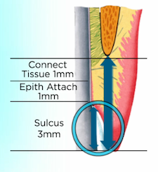 subgingival margin placement figure 2