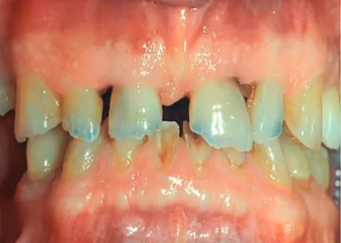 Treatment Planning and Sequencing in Patients With Severe Wear [Ed.]