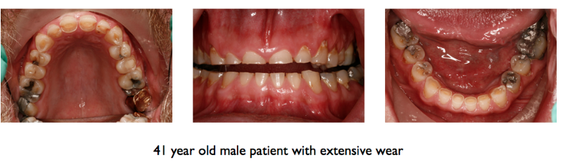 41 year old male patient with extensive wear.