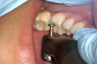 Making Occlusal Adjustments Easier