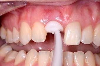 Maintain Tissue Shape on Implant Site