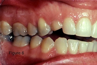 occlusal appliances 1