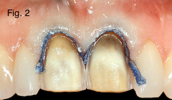 Restoring Discolored Endodontically Treated Teeth Figure 2