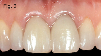 Restoring Discolored Endodontically Treated Teeth Figure 3