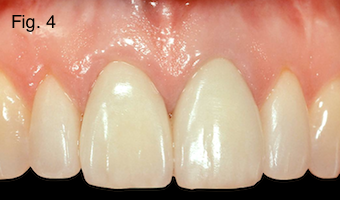 Restoring Discolored Endodontically Treated Teeth Figure 4