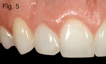 endodontically treated teeth Figure 5