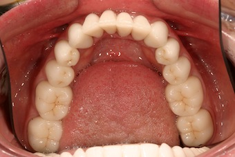 Occlusal Reduction for Indirect Restorations: Is 1.5 mm Enough?