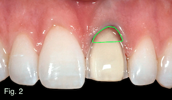 Restoring Discolored Endodontically Treated Teeth Figure 2