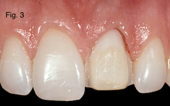 Restoring Discolored Endodontically Treated Teeth Figure 3