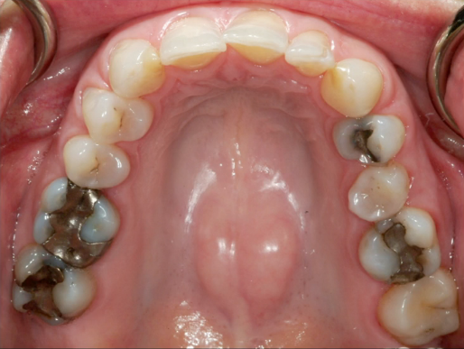  Inlays, Onlays and Veneers vs. Crowns