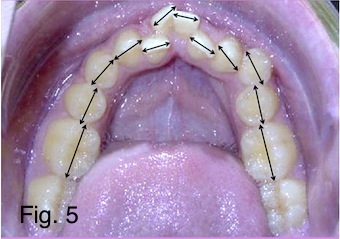 bolton ratio figure 5