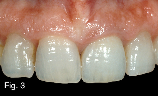 Restoring Discolored Endodontically Treated Teeth: Case 6 - Spear Education