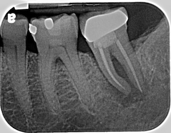 Implant Supported Restoration for a Lower Second Molar