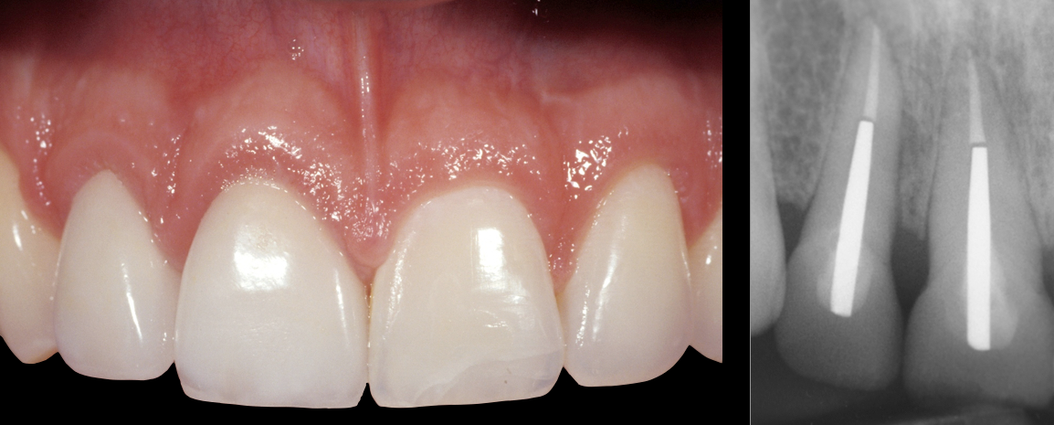 The final dental restorations 8 year post-treatment