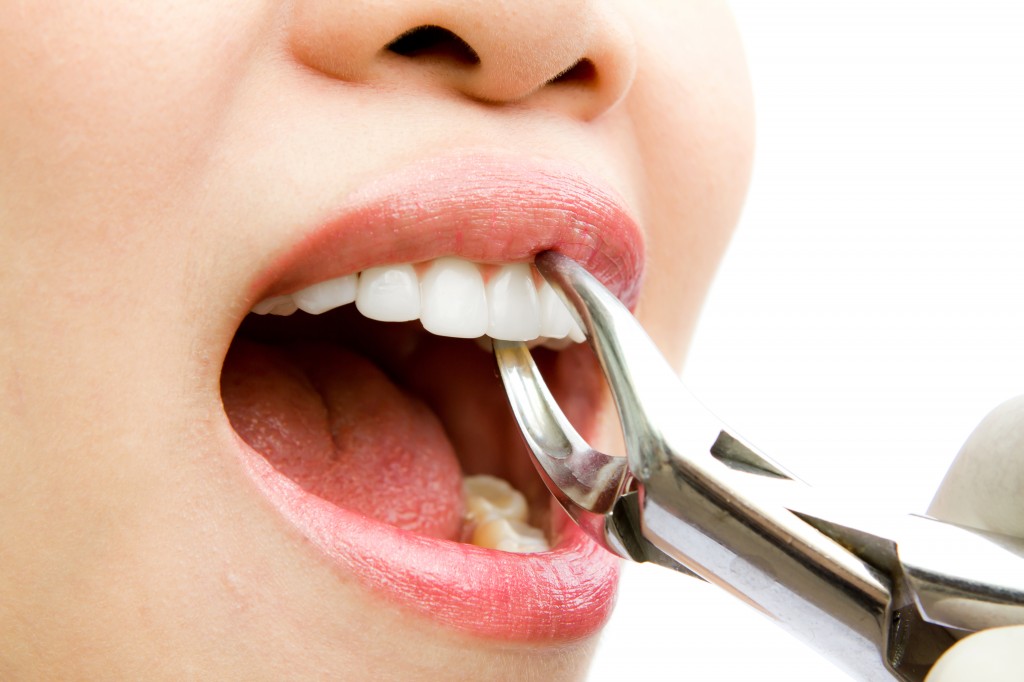 tooth extraction