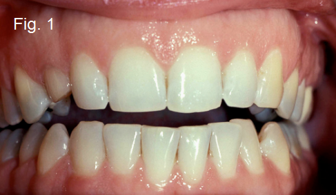 Anterior Open Bites Part III Figure 1
