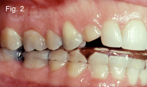 Anterior Open Bites Part III figure 2