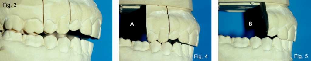 Anterior Open Bites Part III Figures 3-5