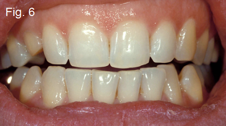 Anterior Open Bites Part III Figure 6