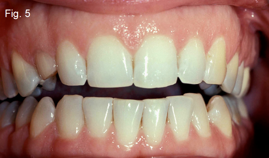 Anterior open bites Figure 5