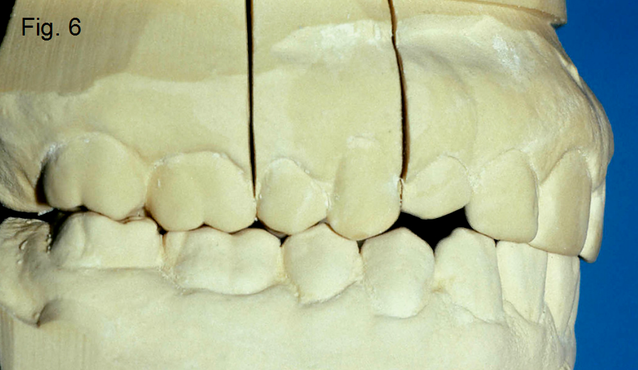 Anterior open bites Figure 6