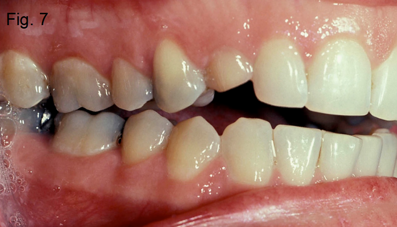 Anterior open bites Figure 7